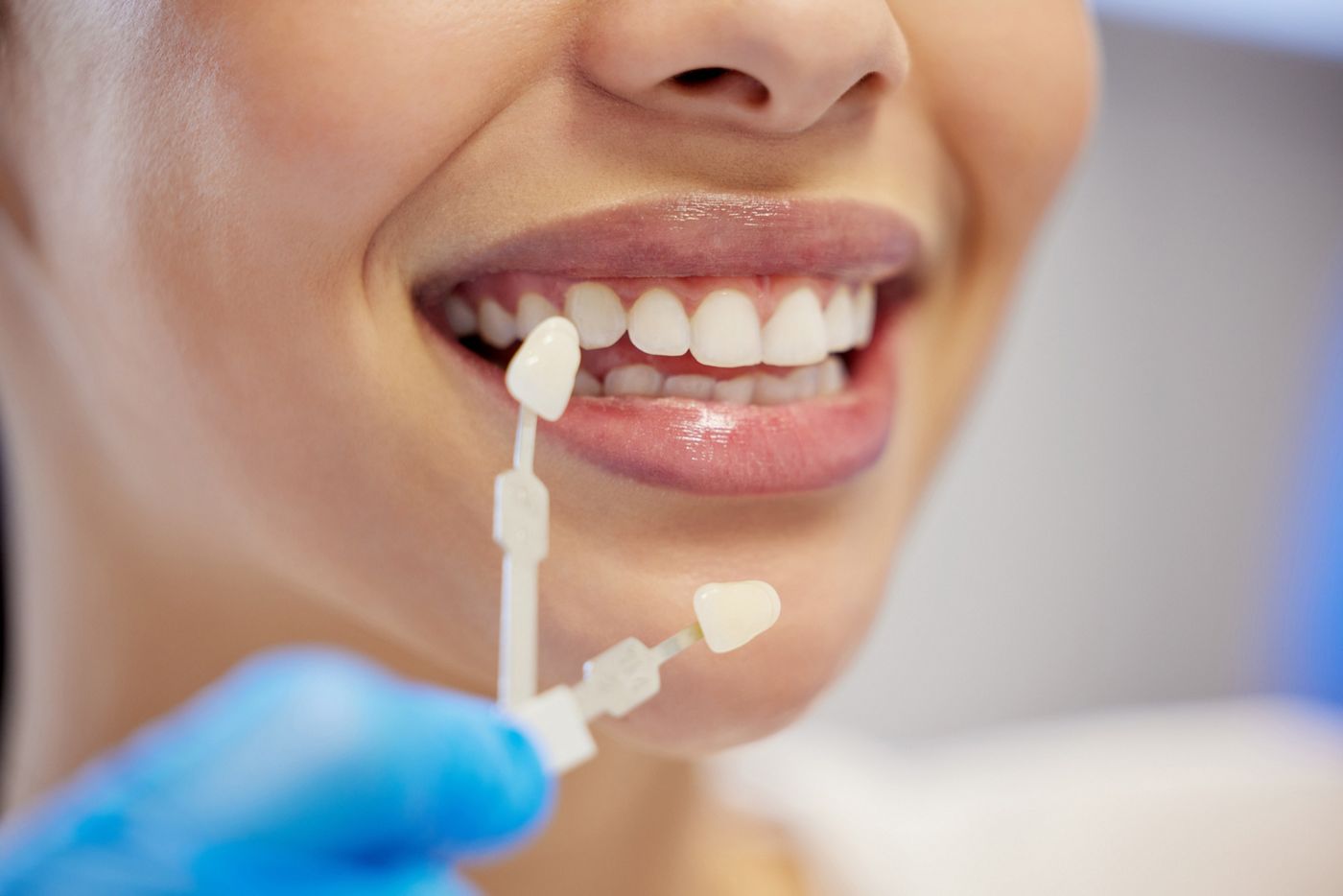 Composite Veneers vs Porcelain Veneers: Before & After Transformation