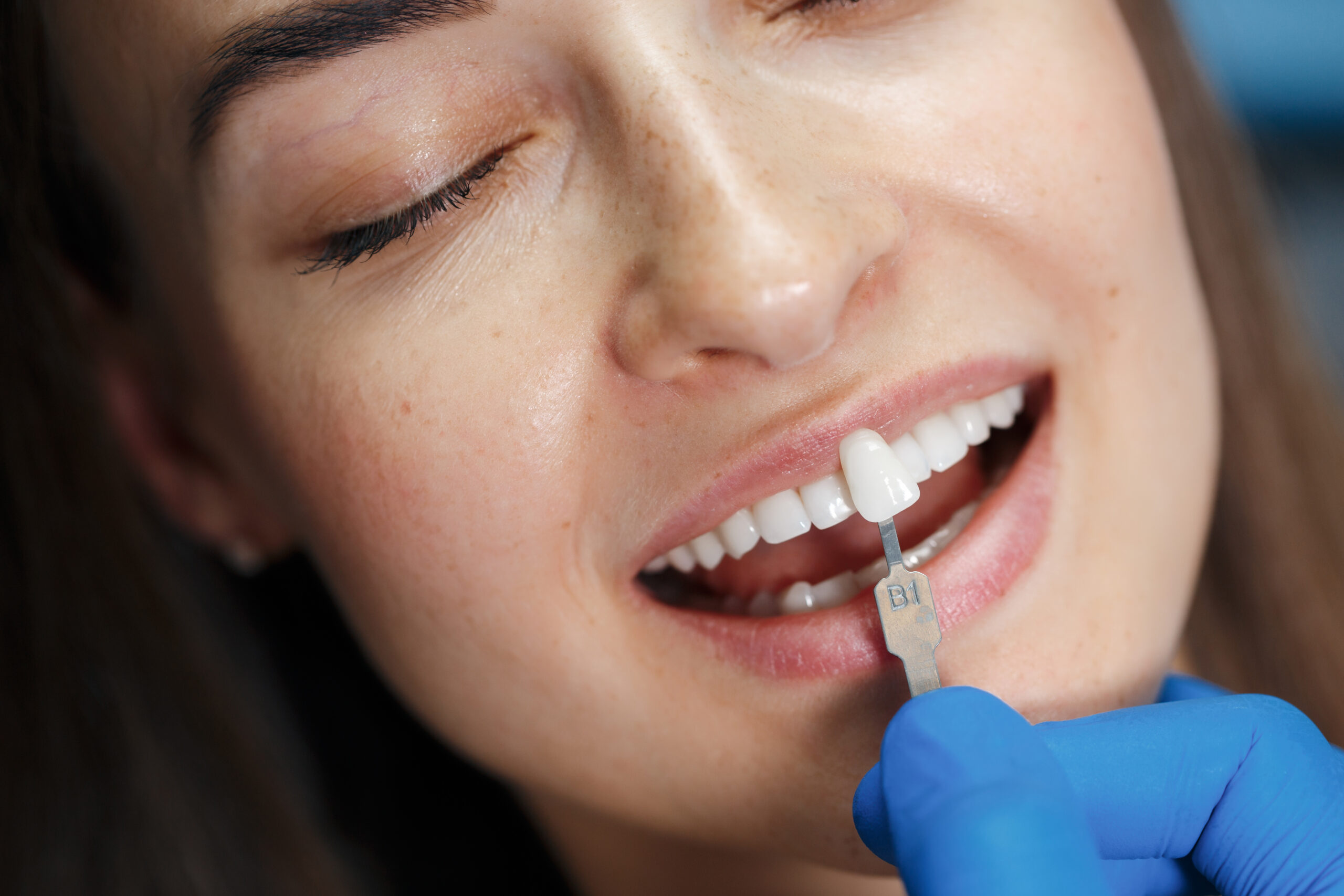 Dental Veneers UK Guide